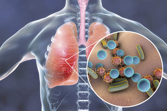 Pulmões humanos com pneumonia e close-up de bactérias e vírus
. — Fotografia de Stock