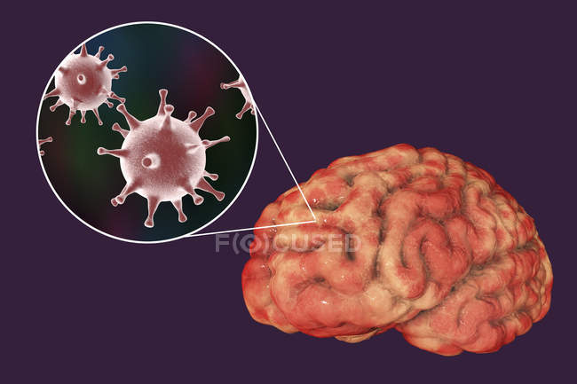 Инфекция мозга, вызванная вирусом герпеса, цифровая иллюстрация
. — стоковое фото