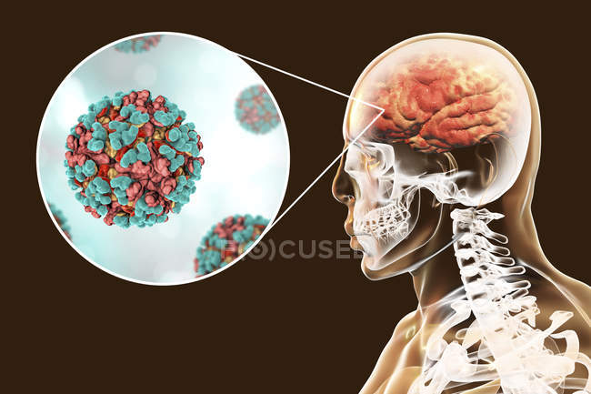 Virus de l'encéphalite équine vénézuélienne infectant le cerveau humain, illustration numérique . — Photo de stock