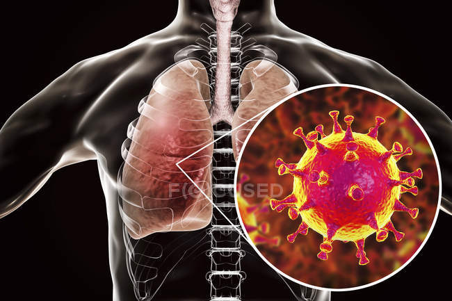Инфекция легких вирусом MERS, концептуальная иллюстрация . — стоковое фото