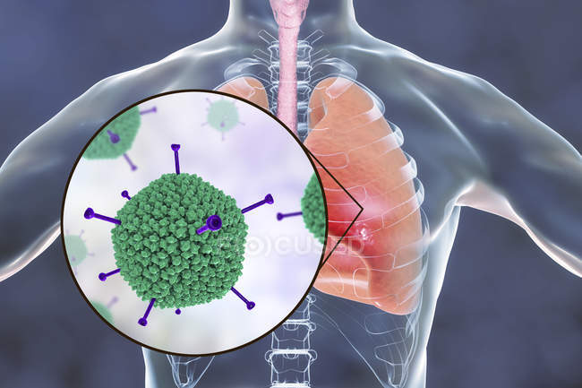 Close-up de adenovírus infectando pulmões humanos, ilustração digital
. — Fotografia de Stock