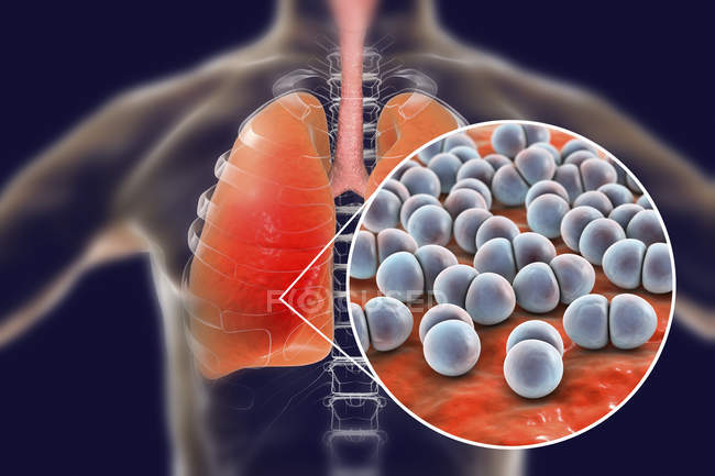 Pneumonia Caused By Streptococcus Pneumoniae Bacteria Conceptual 