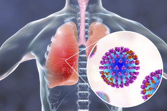 Silhouette humaine avec poumons infectés par la pneumonie causée par la grippe, illustration
. — Photo de stock