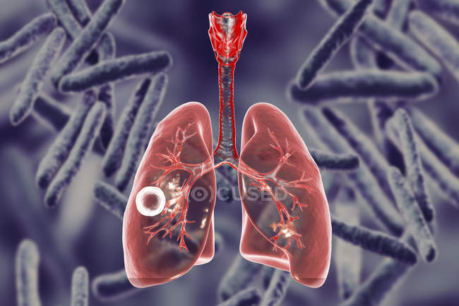 Cavidad fibrosa cavernosa de tuberculosis pulmonar en pulmón derecho con capa fibrosa bien formada
. - foto de stock