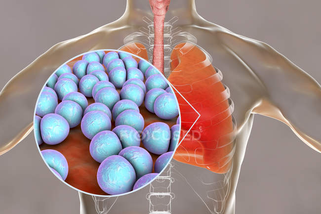 Neumonía causada por la bacteria Streptococcus pneumoniae, ilustración conceptual
. - foto de stock