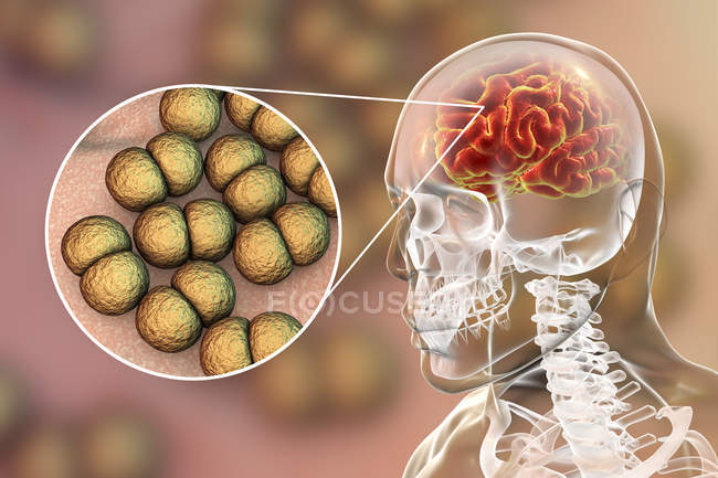 Infección cerebral Neisseria meningitidis, ilustración digital
. - foto de stock