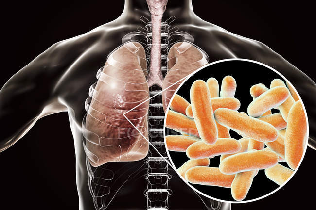 Poumons atteints de la maladie du légionnaire et gros plan sur la bactérie Legionella pneumophila, illustration conceptuelle
. — Photo de stock