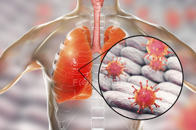 Poumons humains atteints de pneumonie virale et gros plan sur les virions
. — Photo de stock