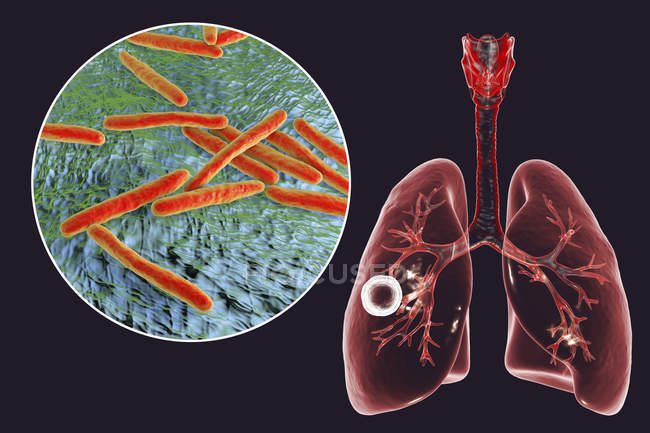 Tuberculosis pulmonar fibrocavernosa y primer plano de la bacteria Mycobacterium tuberculosis
. — Stock Photo