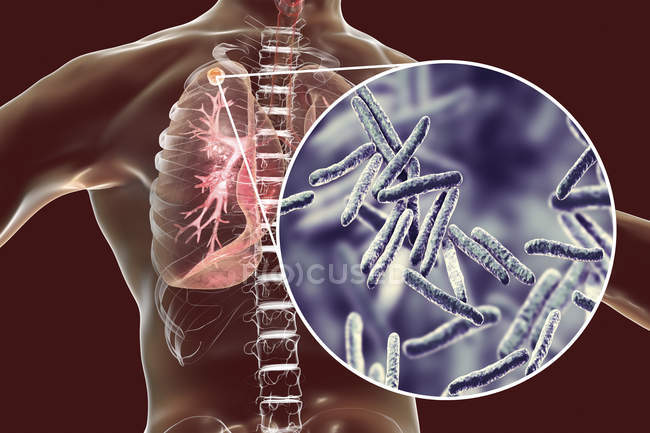 Infecção pulmonar secundária por tuberculose e close-up de bactérias Mycobacterium tuberculosis . — Fotografia de Stock