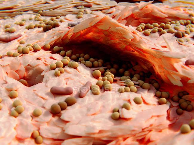 Ilustración de la infección bacteriana de la piel por neurodermatitis estafilocócica . - foto de stock