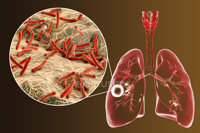 Фіброзна печеристих туберкульоз легенів і макро мікобактерії туберкульозу бактерії. — стокове фото