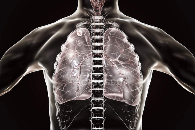 Цифрова ілюстрація твердого вузла в правій легені поблизу апсексу легень під час вторинної інфекції туберкульозу . — стокове фото