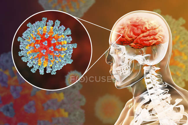 Энцефалит головного мозга человека, вызванный энтеровирусом кори, концептуальная иллюстрация
. — стоковое фото
