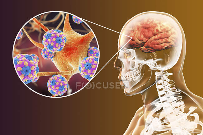 Encefalitis del cerebro humano causada por enterovirus del sarampión, ilustración conceptual . - foto de stock