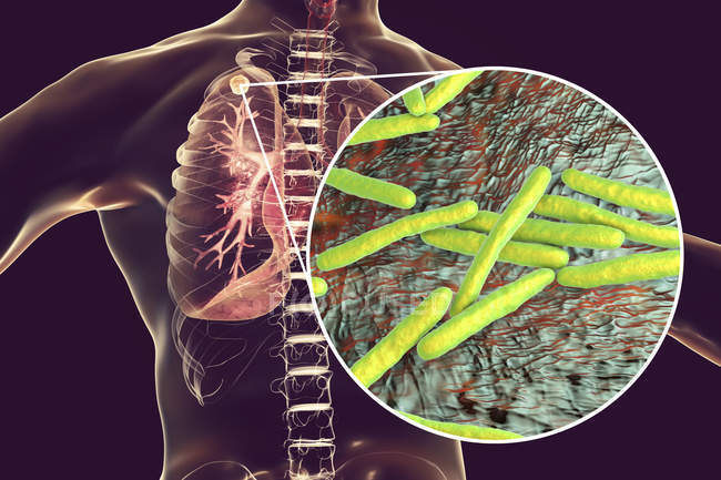 Secondary tuberculosis lungs infection and close-up of Mycobacterium tuberculosis bacteria. — Stock Photo