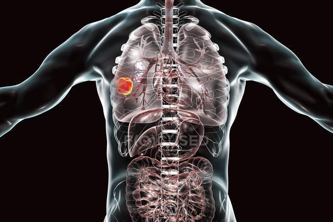 Human silhouette showing lung cancer tumor, conceptual illustration. — Stock Photo