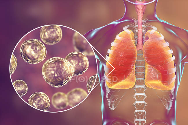Sílhueta humana com pulmões infectados com blastomicose pulmonar e close-up de partículas de fungos Blastomyces dermatitidis . — Fotografia de Stock