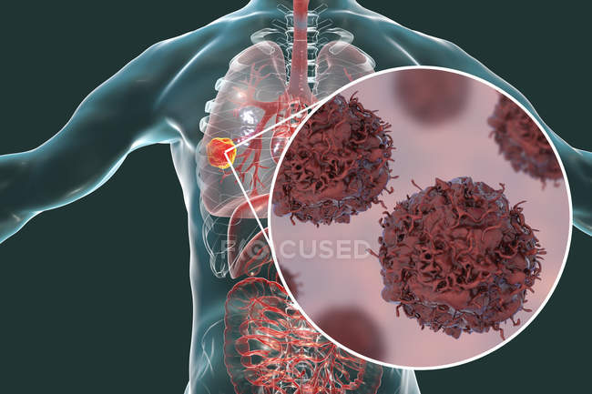 Цифровая иллюстрация раковой опухоли в легких и крупным планом раковых клеток легких
. — стоковое фото