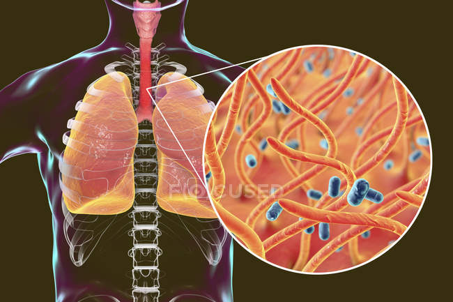 Keuchhusten ansteckende infektiöse Lungenkrankheit und Bordetella-Pertussis-Bakterien in Großaufnahme. — Stockfoto