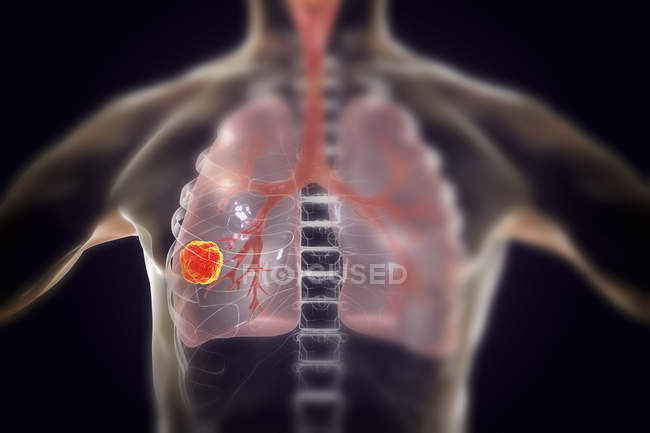 Людського силует показ легенів ракової пухлини, концептуальні ілюстрації. — стокове фото