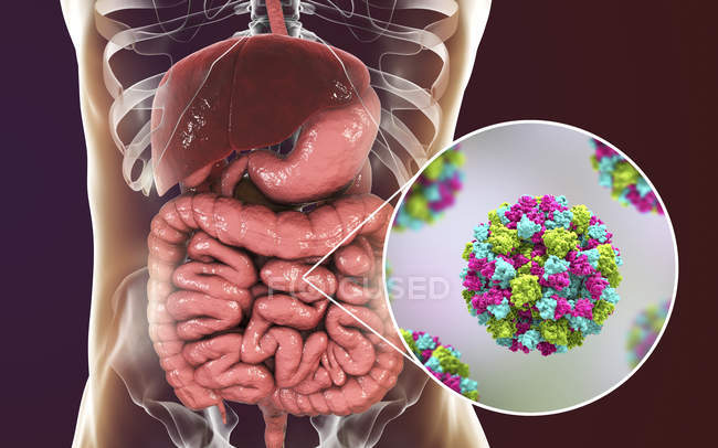 Infección por norovirus en el intestino delgado, ilustración digital
. - foto de stock