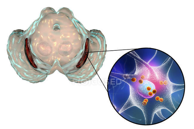 Ilustración digital de sustancia negra degenerada en el cerebro mientras la enfermedad de Parkinsons
. - foto de stock