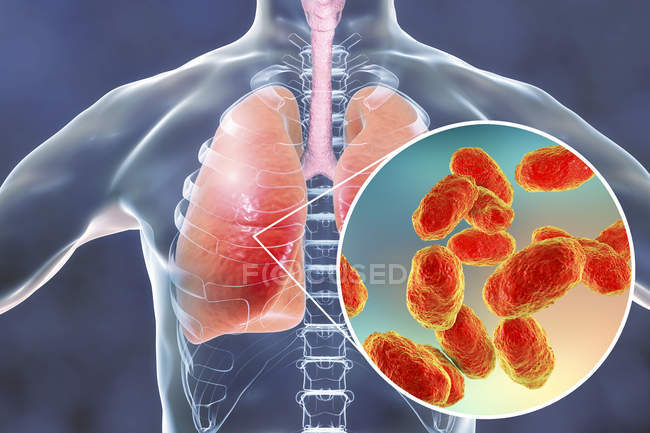 Neumonía pulmonar y primer plano de la bacteria Haemophilus influenzae, ilustración digital
. - foto de stock