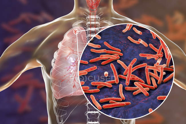 Infección pulmonar secundaria por tuberculosis y primer plano de la bacteria Mycobacterium tuberculosis
. — Stock Photo
