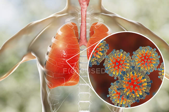Силует з пневмонією легенів викликані вірус кору, концептуальні ілюстрації. — Stock Photo