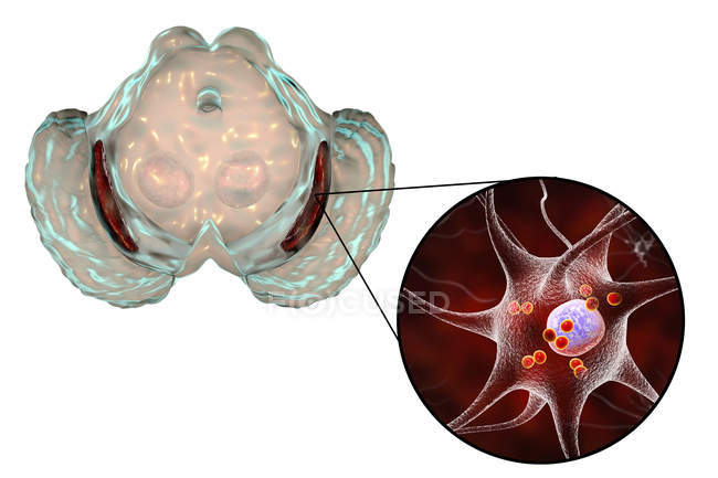 Цифровая иллюстрация выродившейся чёрной субстанции в мозгу во время болезни Паркинсона
. — стоковое фото