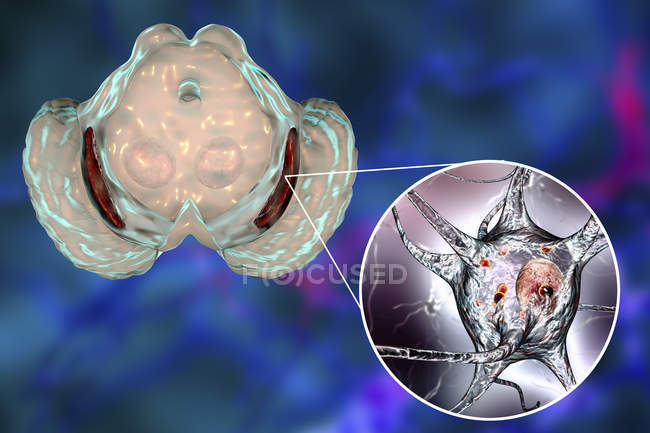 Цифровий ілюстрація виродилось substantia nigra в мозку при хвороба Паркінсона. — стокове фото