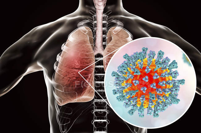 Silueta con neumonía pulmonar causada por el virus del sarampión, ilustración conceptual
. - foto de stock