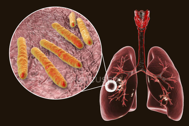 Tuberculosis pulmonar fibrocavernosa y primer plano de la bacteria Mycobacterium tuberculosis
. - foto de stock