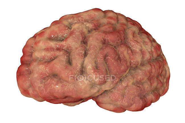 Цифровая иллюстрация мозга с признаками энцефалита
. — стоковое фото