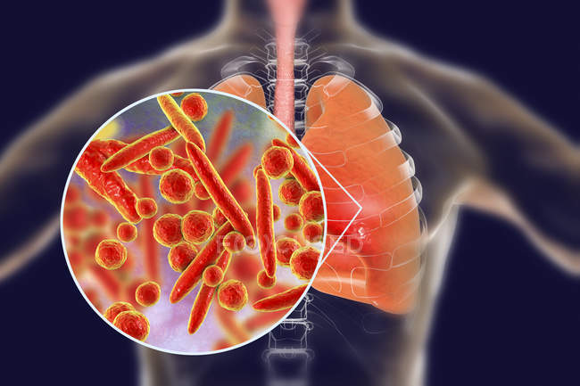 Пневмонія легенів викликані бактерії Mycoplasma pneumoniae, концептуальні ілюстрації. — стокове фото