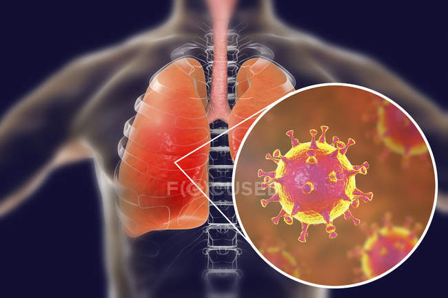 Infecção pelo vírus MERS dos pulmões, ilustração conceitual
. — Fotografia de Stock