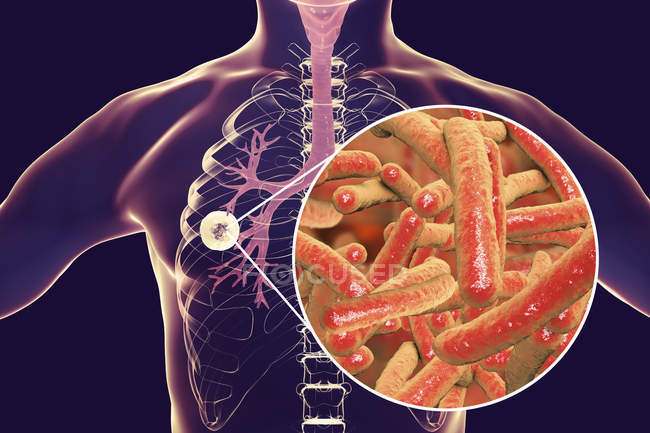 Фиброзно-легочный клубень и бактерии Mycobactum tuberculosis
. — стоковое фото