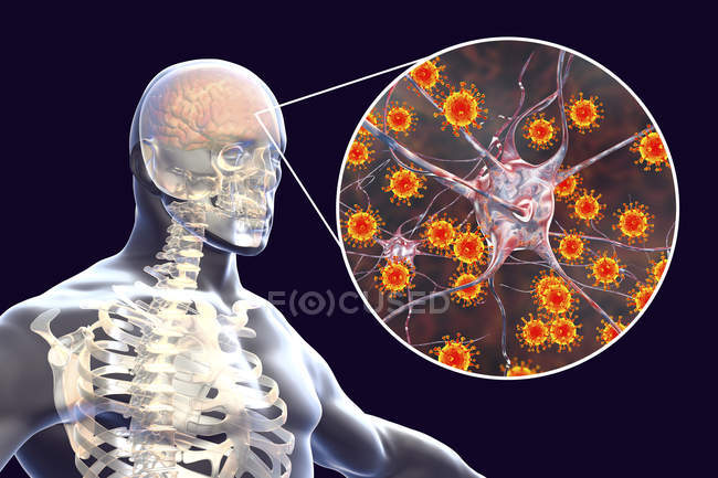 Ilustración conceptual del cerebro humano con signos de encefalitis viral y primer plano de partículas virales
. - foto de stock