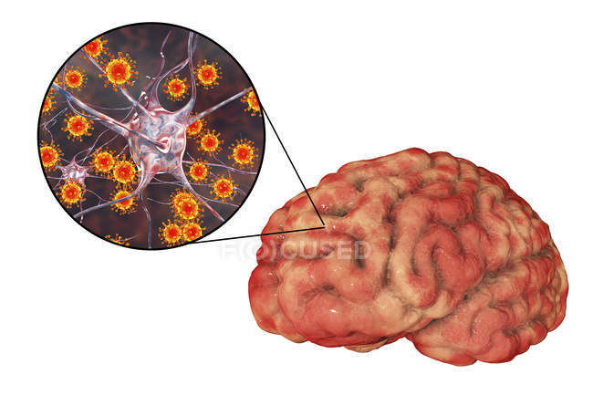 Konzeptionelle Darstellung des Gehirns mit Anzeichen einer viralen Enzephalitis und Nahaufnahme von Virionen. — Stockfoto