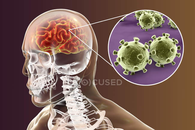 Conceptual illustration of human brain with signs of viral encephalitis and close-up of virus particles. — Stock Photo