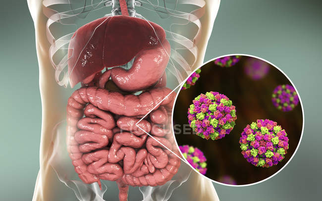 Infecção por norovírus no intestino delgado, ilustração digital
. — Fotografia de Stock