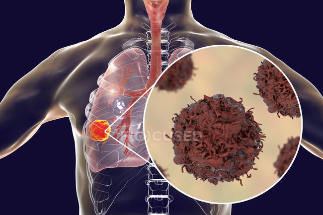 Цифровий ілюстрація ракової пухлини в легенях і Закри клітин раку легенів. — стокове фото
