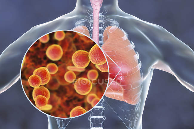 Neumonía pulmonar causada por la bacteria Mycoplasma pneumoniae, ilustración conceptual
. - foto de stock
