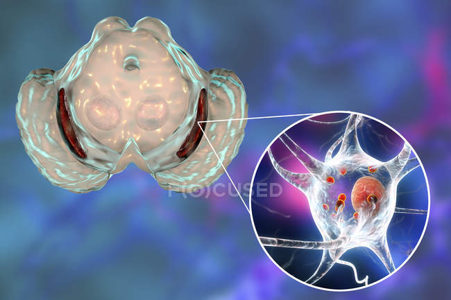 Ilustración digital de sustancia negra degenerada en el cerebro mientras la enfermedad de Parkinsons
. - foto de stock