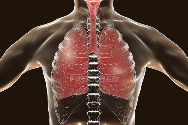 Tuberculosis miliar en los pulmones humanos, ilustración digital . - foto de stock
