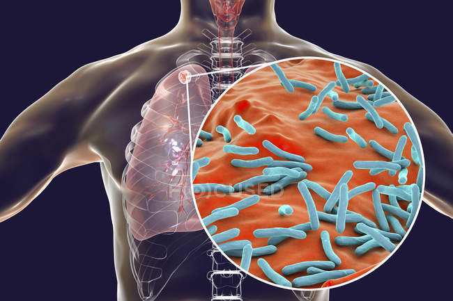 Infección pulmonar secundaria por tuberculosis y primer plano de la bacteria Mycobacterium tuberculosis
. — Stock Photo