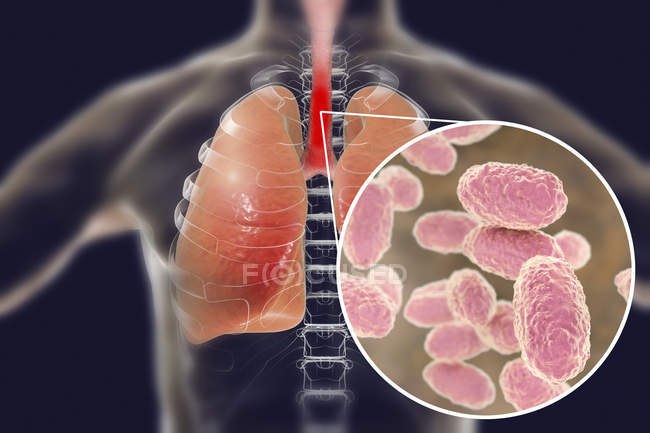 Whooping Cough Contagious Infectious Lungs Disease And Close up Of 