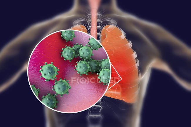 Human lungs with viral pneumonia and close-up of virions. — Stock Photo
