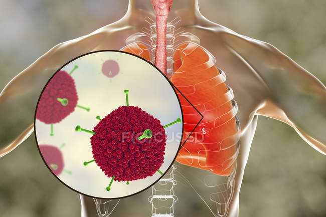 Close-up de adenovírus infectando pulmões humanos, ilustração digital . — Fotografia de Stock